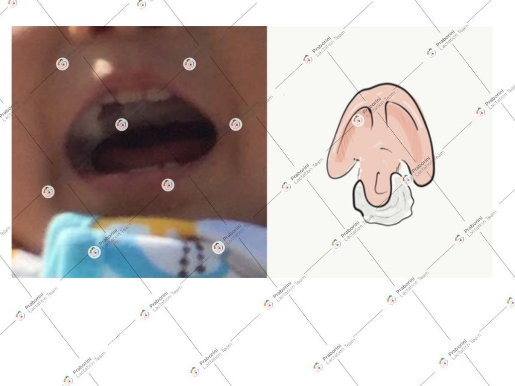 Breastfeeding Baby with Cleft Lip and Palate a Case Report Praborini Lactation Team